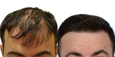 FUE Hair Transplant Before & After Gallery - Patient 372058 - Image 1