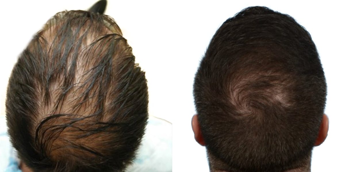 FUE Hair Transplant Before & After Gallery - Patient 372058 - Image 2