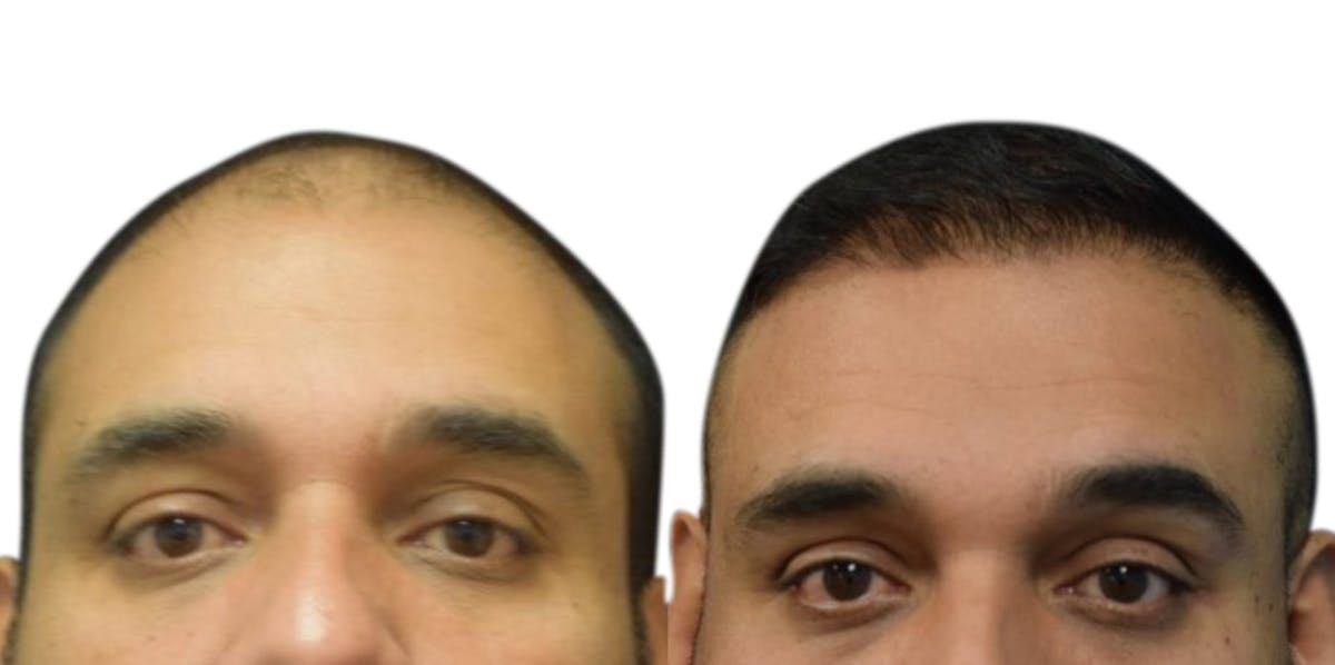 Hair Restoration Before & After Gallery - Patient 138085 - Image 1