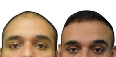FUE Hair Transplant Before & After Gallery - Patient 714890 - Image 1