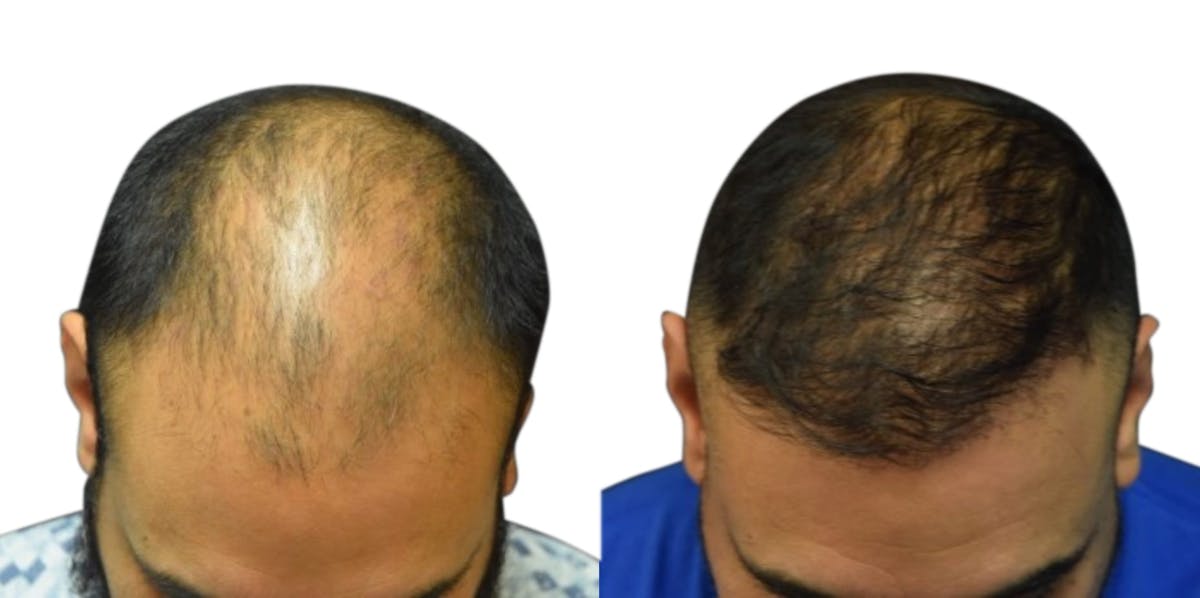 Hair Restoration Before & After Gallery - Patient 138085 - Image 2