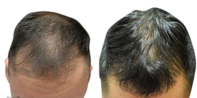 FUE Hair Transplant Before & After Gallery - Patient 250333 - Image 1