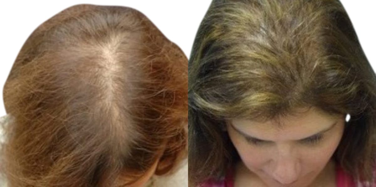 Female Hair Restoration Before & After Gallery - Patient 195073 - Image 1