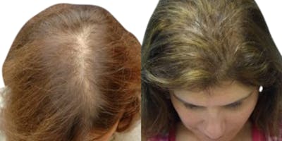 Female Hair Restoration Before & After Gallery - Patient 195073 - Image 1