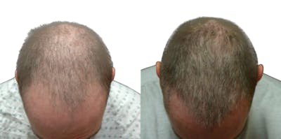 FUE Hair Transplant Before & After Gallery - Patient 261577 - Image 1