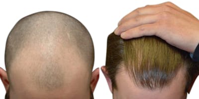 FUE Hair Transplant Before & After Gallery - Patient 147337 - Image 1