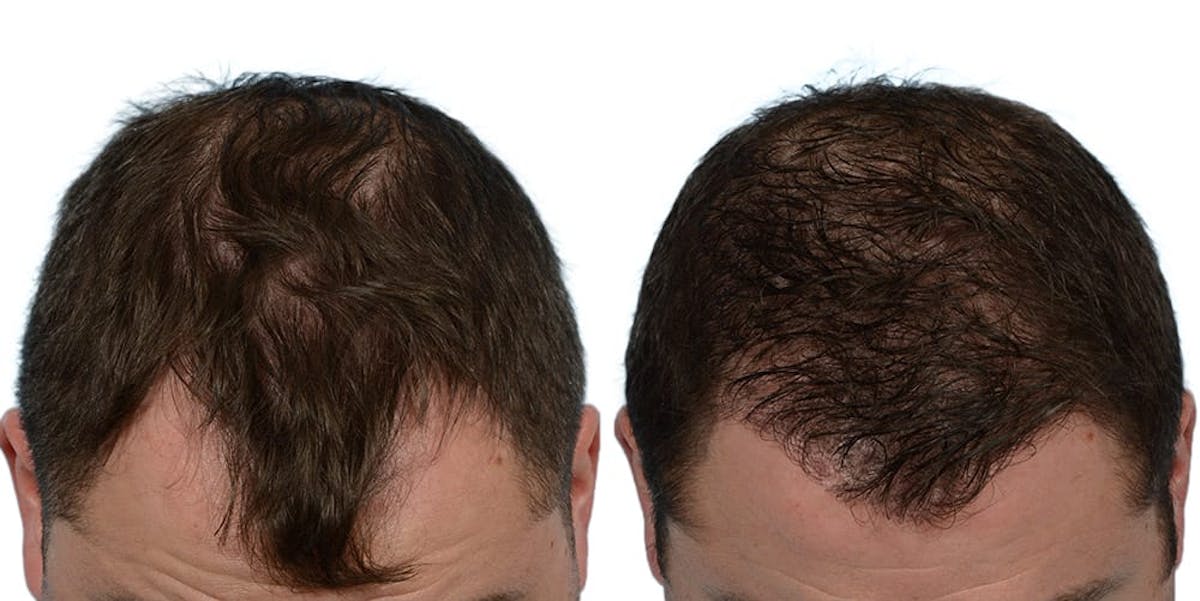 FUE Hair Transplant Before & After Gallery - Patient 422298 - Image 1