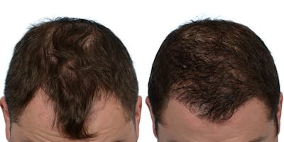 FUE Hair Transplant Before & After Gallery - Patient 422298 - Image 1