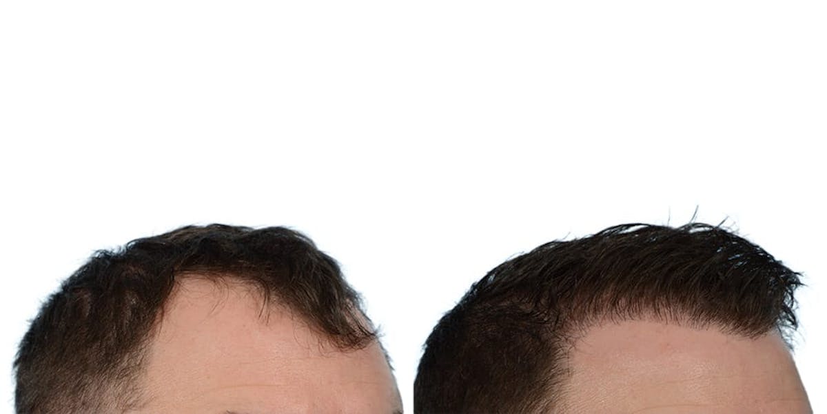 FUE Hair Transplant Before & After Gallery - Patient 422298 - Image 2