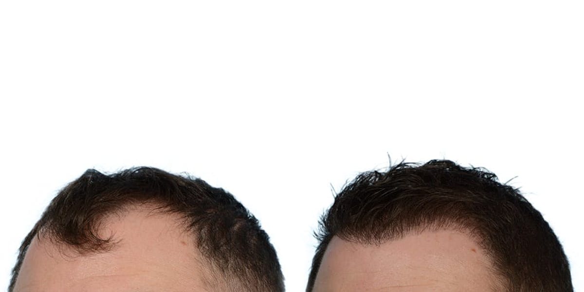 Hair Restoration Before & After Gallery - Patient 244759 - Image 3
