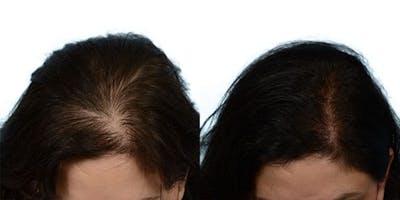 Female Hair Restoration Before & After Gallery - Patient 129110 - Image 1