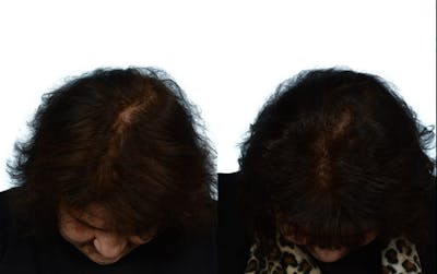 Female Hair Restoration Before & After Gallery - Patient 149688 - Image 1