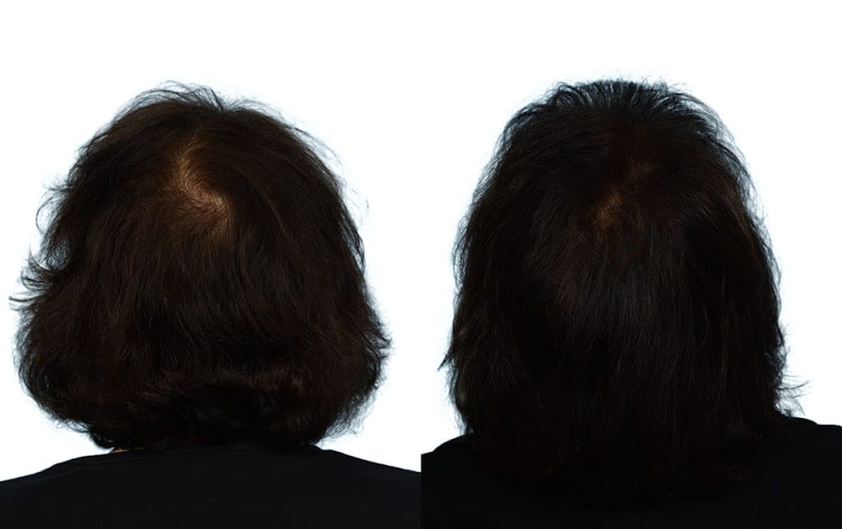 FUE Hair Transplant Before & After Gallery - Patient 201060 - Image 2