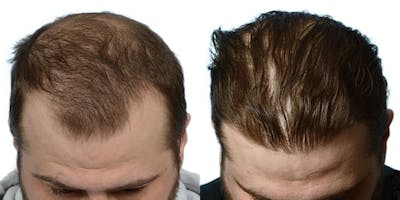 FUE Hair Transplant Before & After Gallery - Patient 167017 - Image 1