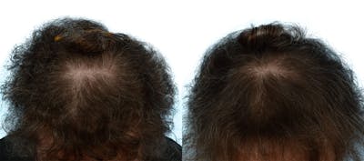 FUE Hair Transplant Before & After Gallery - Patient 102617 - Image 1