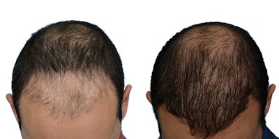 Hair Restoration Before & After Gallery - Patient 307898 - Image 1