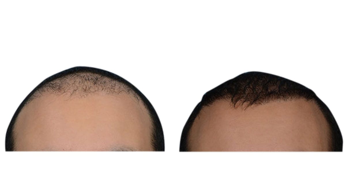 Hair Restoration Before & After Gallery - Patient 307898 - Image 2