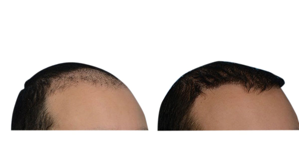 Hair Restoration Before & After Gallery - Patient 307898 - Image 3