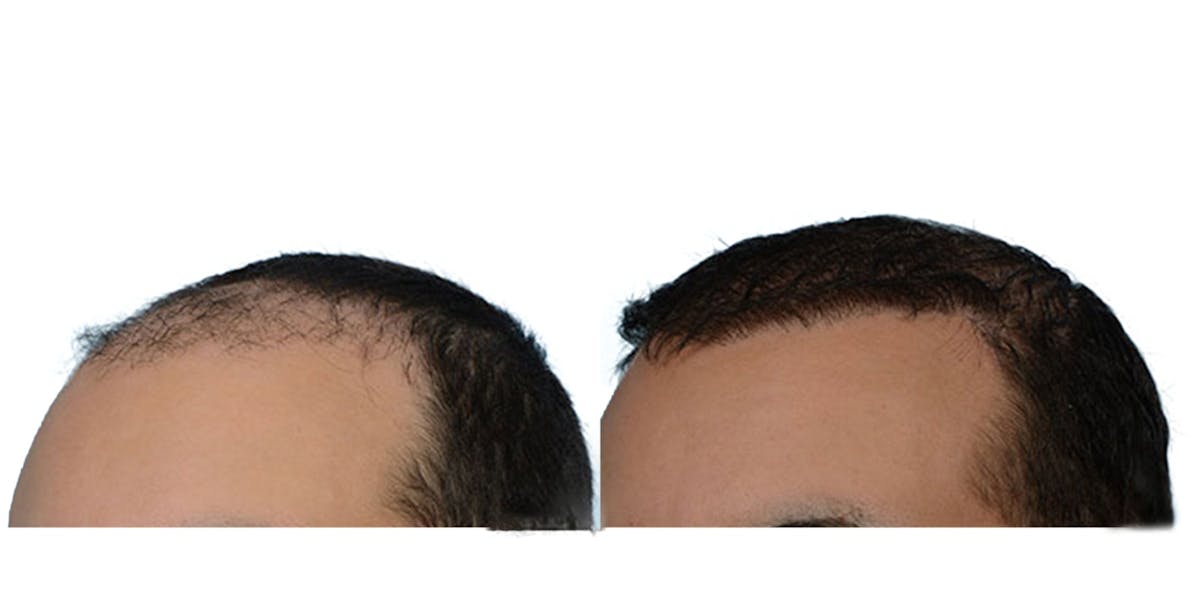 Hair Restoration Before & After Gallery - Patient 307898 - Image 4