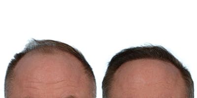 FUE Hair Transplant Before & After Gallery - Patient 145086 - Image 1