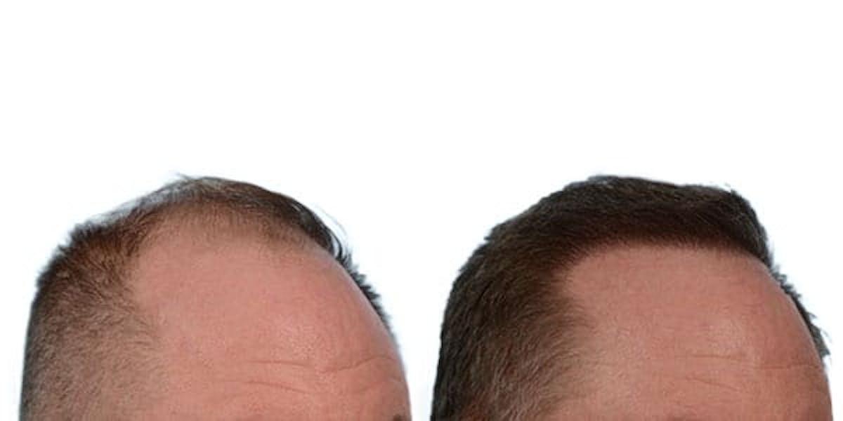 Hair Restoration Before & After Gallery - Patient 302391 - Image 2
