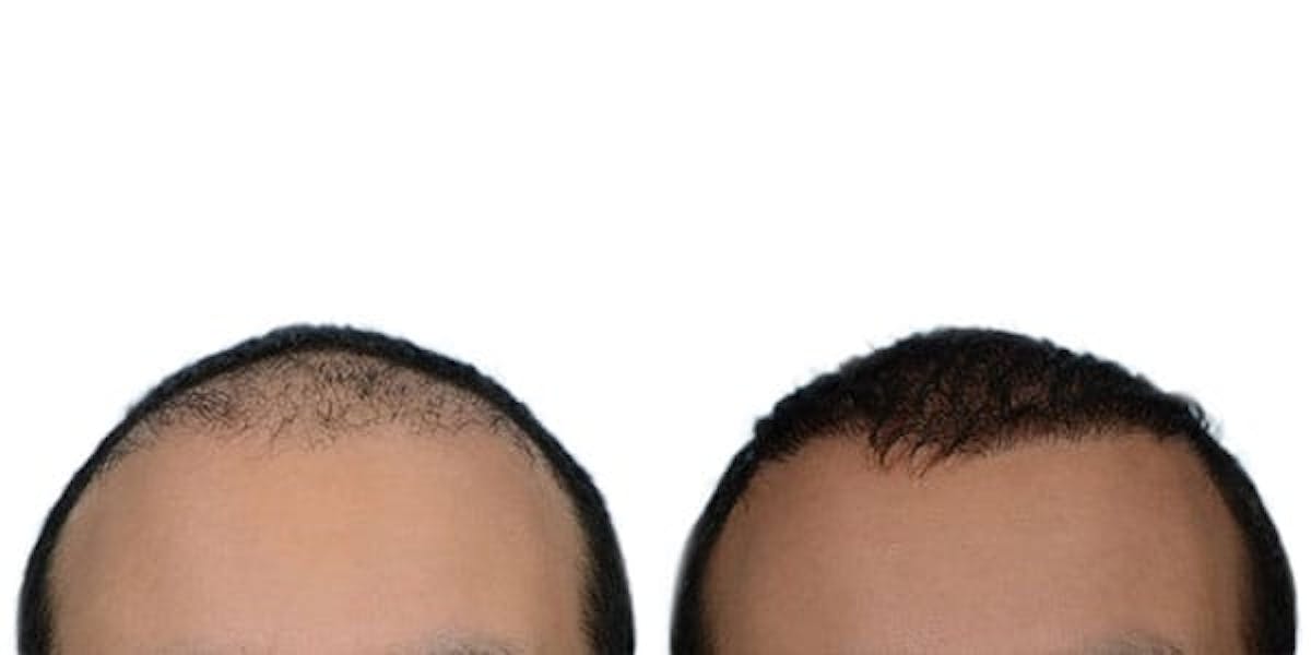 FUE Hair Transplant Before & After Gallery - Patient 420180 - Image 1
