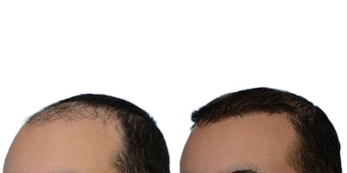 FUE Hair Transplant Before & After Gallery - Patient 420180 - Image 2