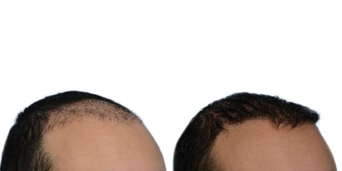 FUE Hair Transplant Before & After Gallery - Patient 420180 - Image 3