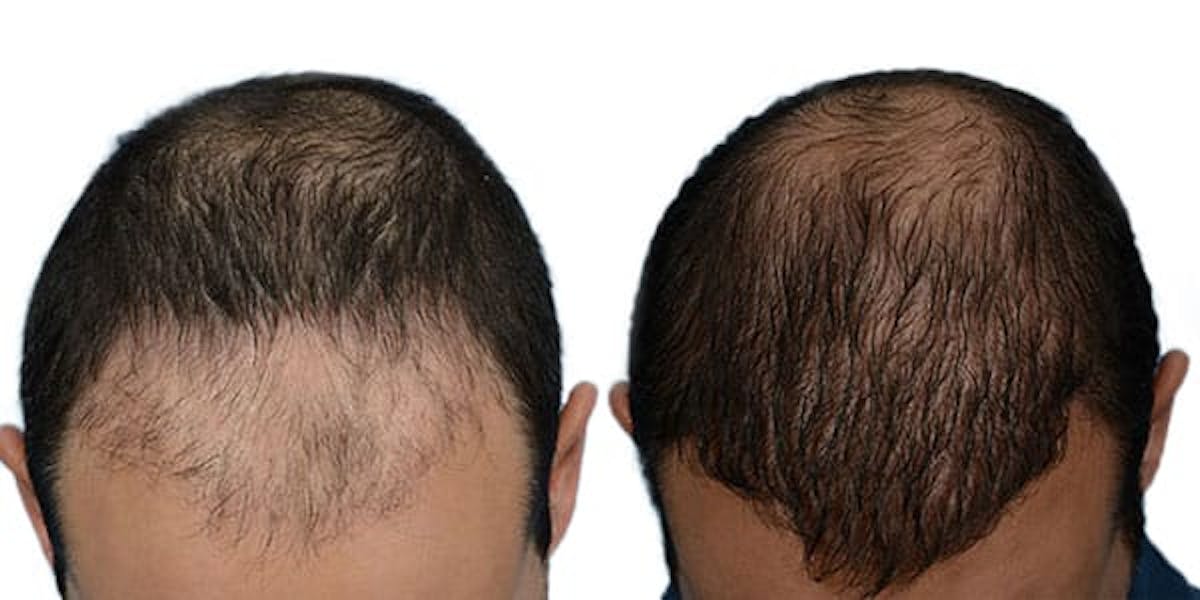 FUE Hair Transplant Before & After Gallery - Patient 420180 - Image 4