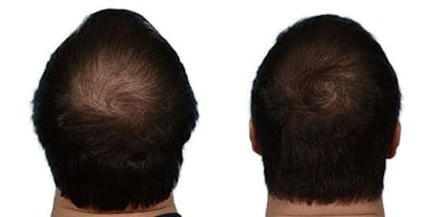 FUE Hair Transplant Before & After Gallery - Patient 110404 - Image 1