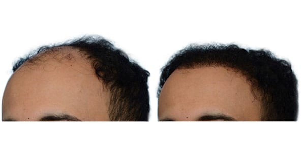 FUE Hair Transplant Before & After Gallery - Patient 133109 - Image 1