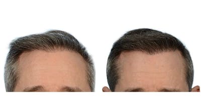 Hair Restoration Before & After Gallery - Patient 333626 - Image 1