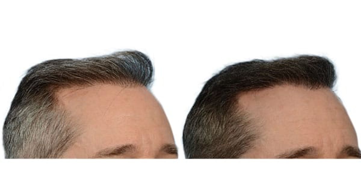 FUE Hair Transplant Before & After Gallery - Patient 397452 - Image 2