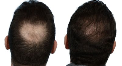 FUE Hair Transplant Before & After Gallery - Patient 302651 - Image 1