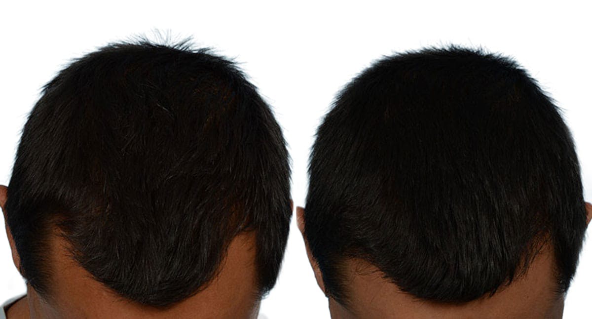 Hair Restoration Before & After Gallery - Patient 282479 - Image 1