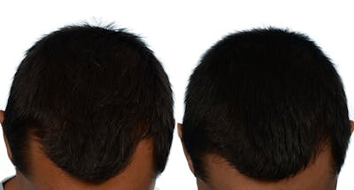 FUE Hair Transplant Before & After Gallery - Patient 238623 - Image 1