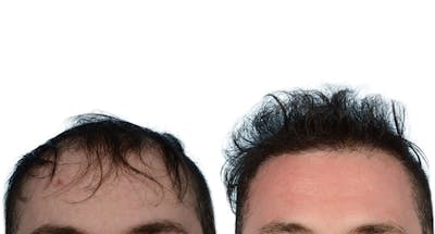 FUE Hair Transplant Before & After Gallery - Patient 343888 - Image 1