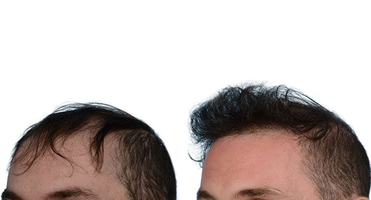 Hair Restoration Before & After Gallery - Patient 364770 - Image 2