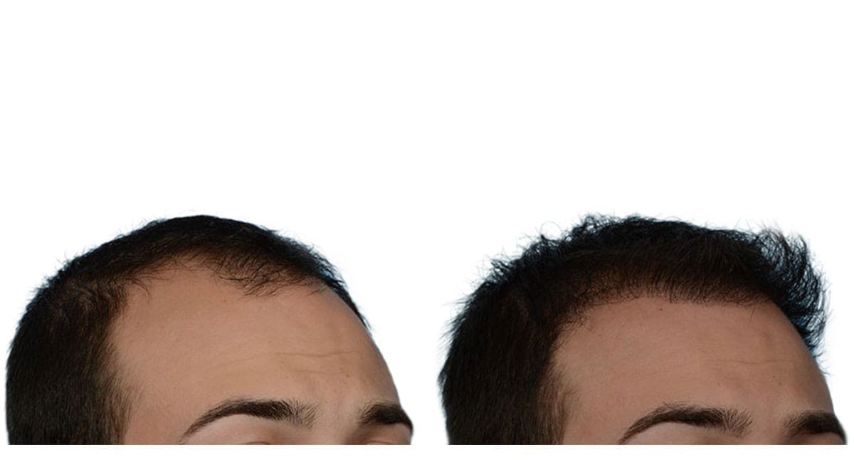 Hair Restoration Before & After Gallery - Patient 153326 - Image 2
