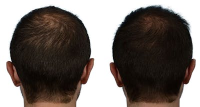 FUE Hair Transplant Before & After Gallery - Patient 340609 - Image 1