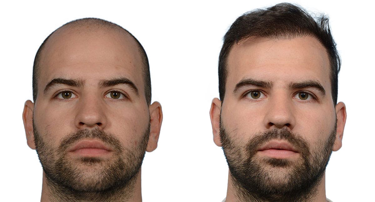 Hair Restoration Before & After Gallery - Patient 277301 - Image 1