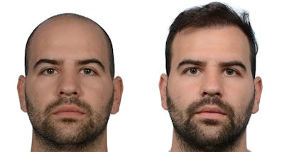 FUE Hair Transplant Before & After Gallery - Patient 348084 - Image 1