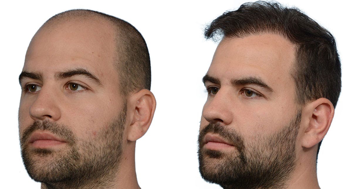 Hair Restoration Before & After Gallery - Patient 277301 - Image 2
