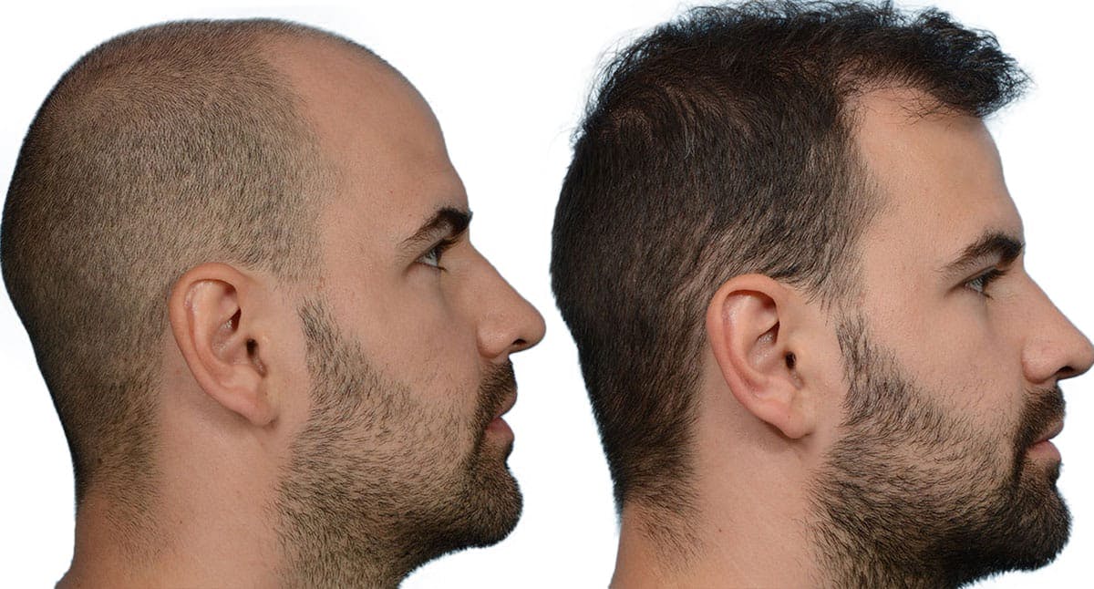 FUE Hair Transplant Before & After Gallery - Patient 348084 - Image 3
