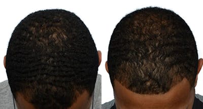 FUE Hair Transplant Before & After Gallery - Patient 244308 - Image 1