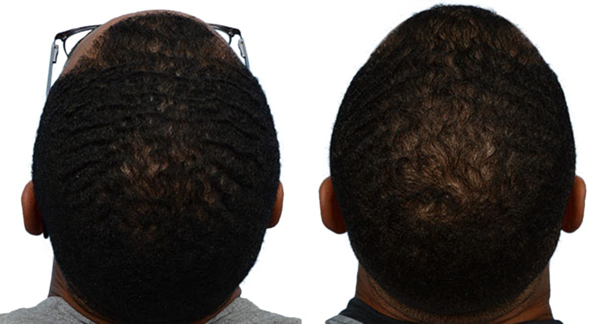 Hair Restoration Before & After Gallery - Patient 171385 - Image 2