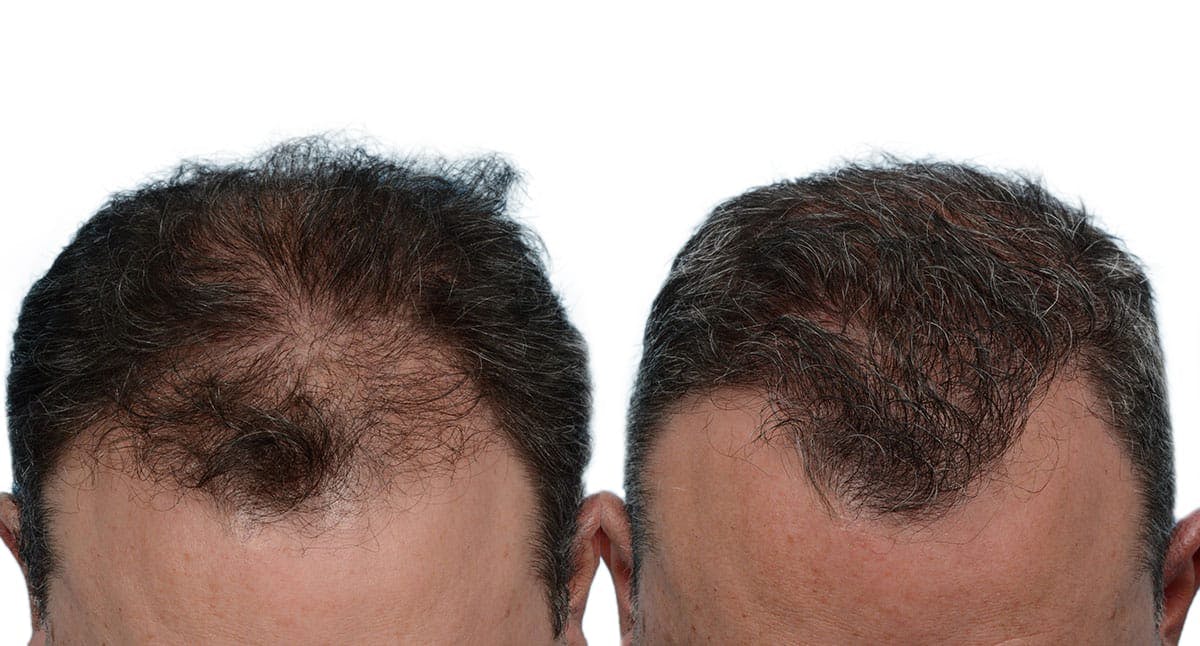 Hair Restoration Before & After Gallery - Patient 354714 - Image 2