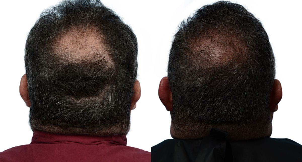 FUE Hair Transplant Before & After Gallery - Patient 252545 - Image 1