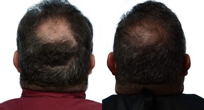 FUE Hair Transplant Before & After Gallery - Patient 252545 - Image 1