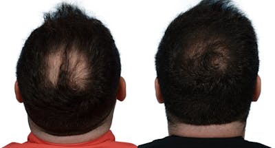 Hair Restoration Before & After Gallery - Patient 780439 - Image 1